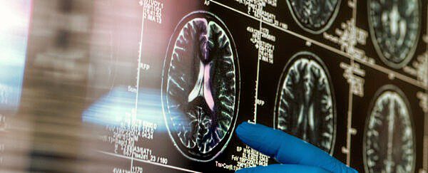 High-Dose Vitamin D May Delay Early Signs of Multiple Sclerosis